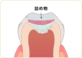 詰め物