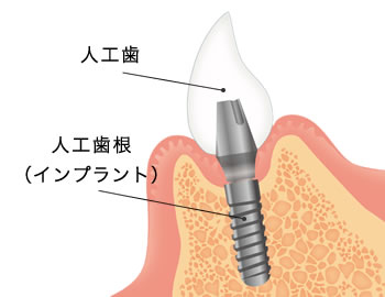 インプラント