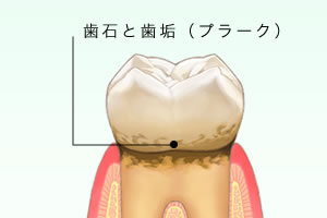 歯石除去